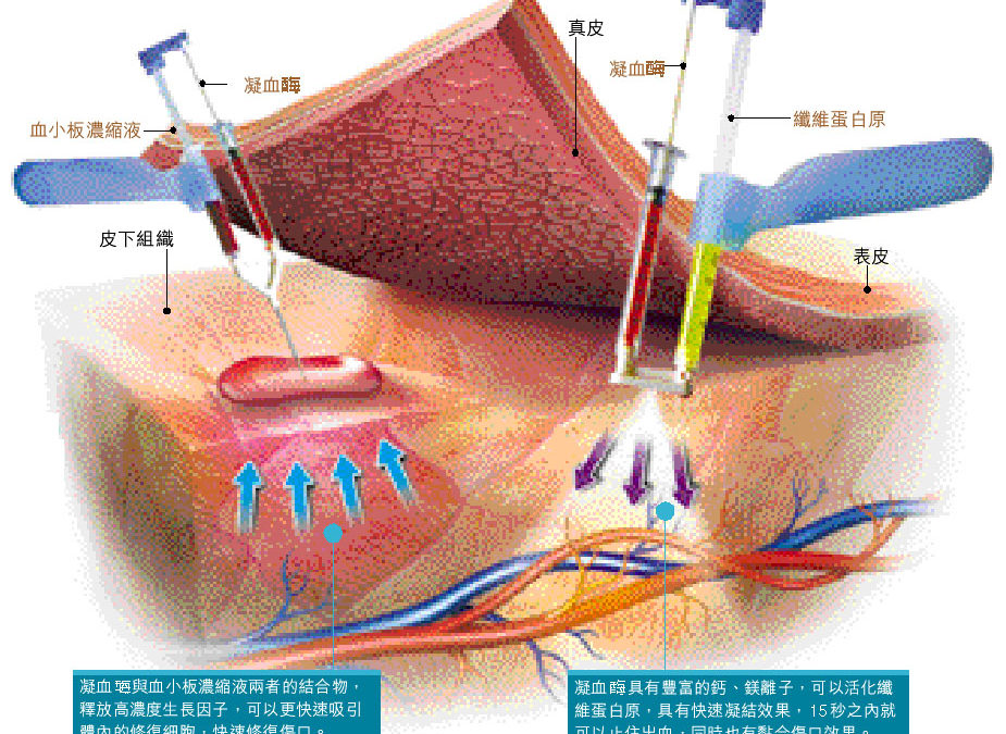 The forefront of medical treatment, a new weapon to restore:Hemostatic three-second glue